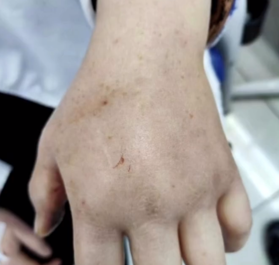 女子被石头鱼刺伤整条胳膊肿胀 医生提醒：高档海鲜 鳍有剧毒