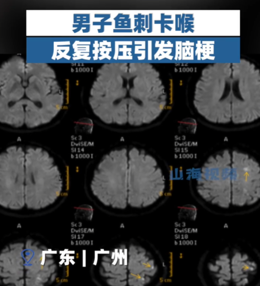 男子鱼刺卡喉反复按压致脑梗！医生提醒：当心动脉血管壁内膜撕裂