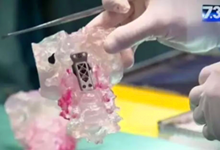 澳大利亚首次用3D打印椎骨在“人头分离”情况下完成替换手术