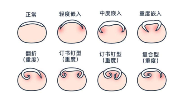 困扰十几亿人!脚趾甲咋会向肉里长?