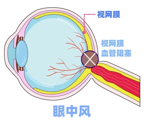 95后妈妈一觉醒来右眼失明！医生：已错过最佳抢救时机