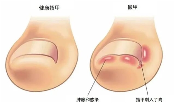 困扰十几亿人!脚趾甲咋会向肉里长?
