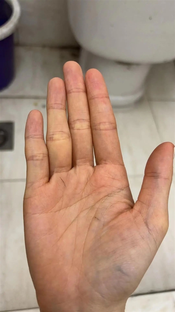 食指比无名指短 更容易精神病吗