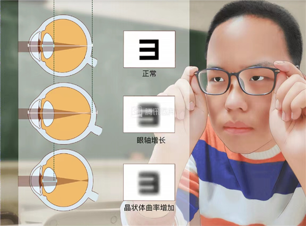 眼科医生自己真的都不做近视手术?