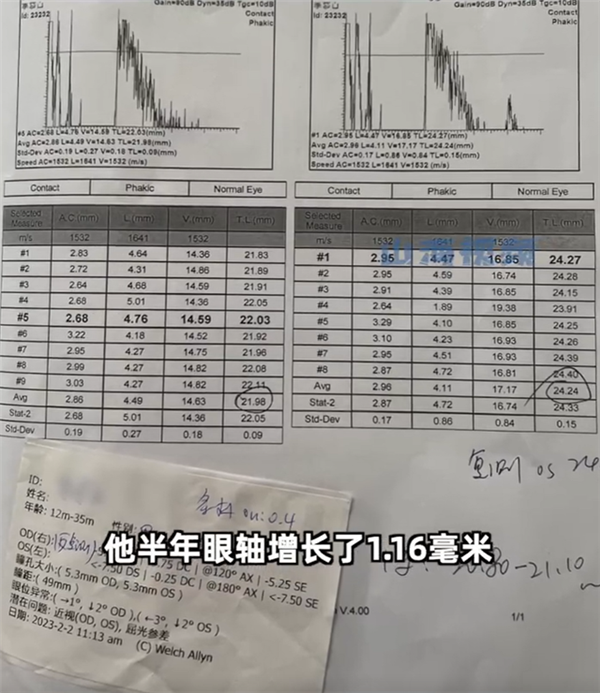 父母高度近视 1岁婴儿近视600度:快速恶化 最快可能失明