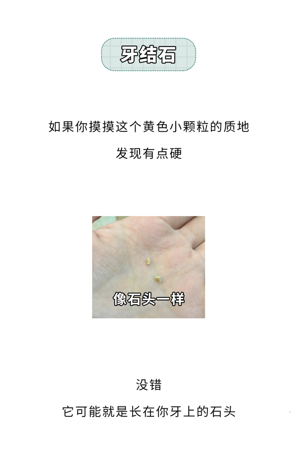 重口味科普！嘴里咳出来贼臭的黄色小颗粒：到底是啥？