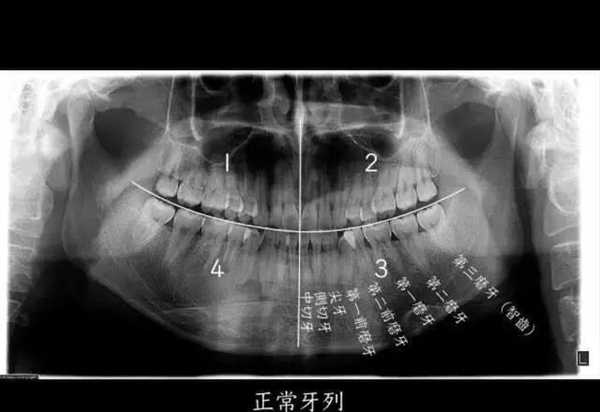 24岁小伙拔牙后晕倒 开颅手术后去世！智齿还能拔吗