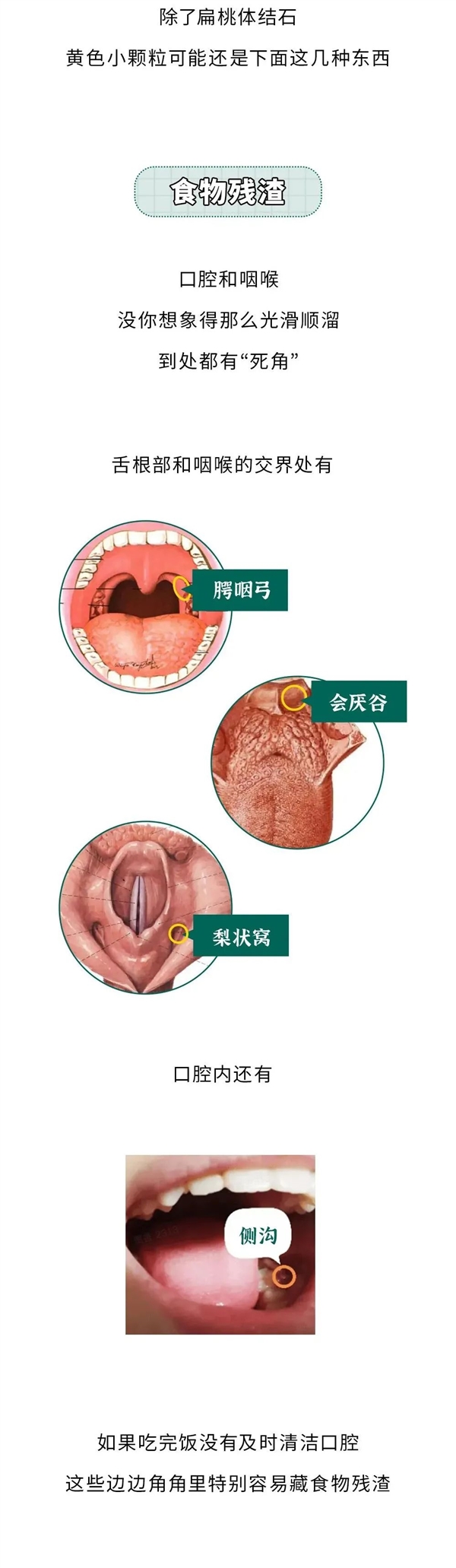 重口味科普！嘴里咳出来贼臭的黄色小颗粒：到底是啥？