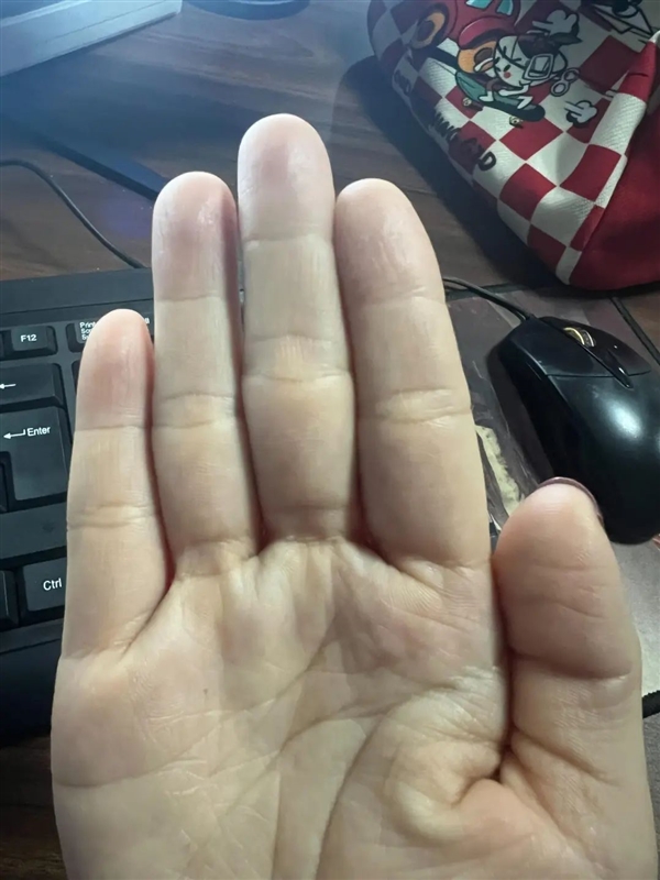 食指比无名指短 更容易精神病吗