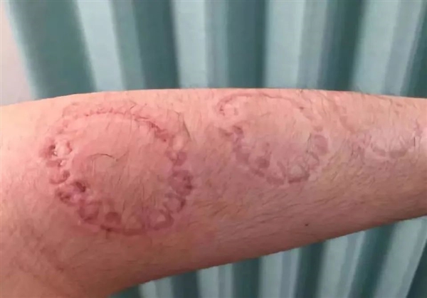 被人咬伤 感染概率高达55%!人嘴里到底有啥致病菌?