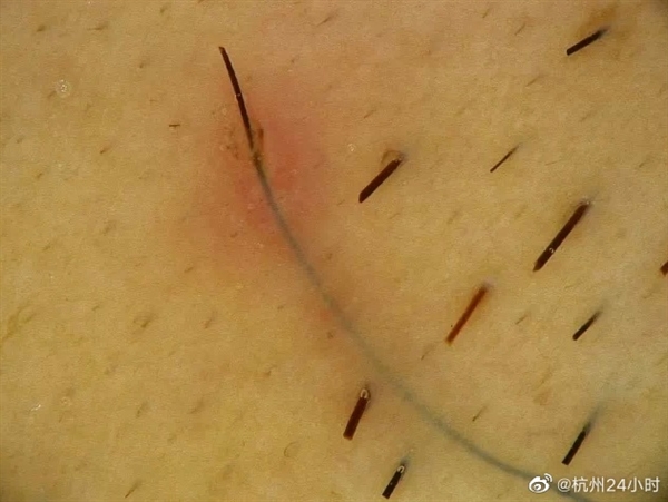 男子患罕见病“皮肤毛发移行疹”:全球报道仅40例