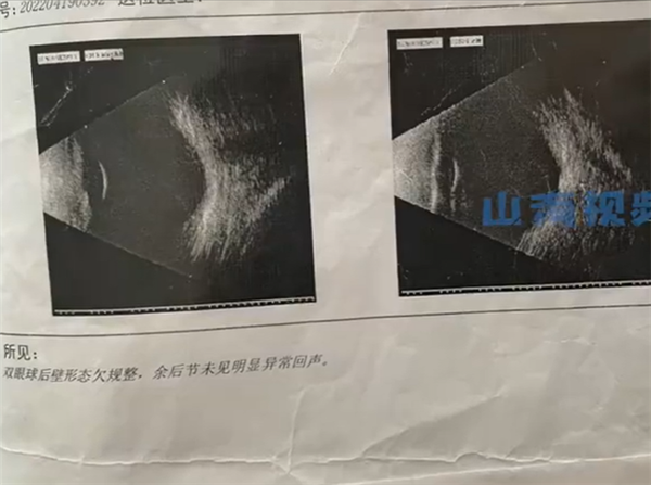 父母高度近视 1岁婴儿近视600度:快速恶化 最快可能失明