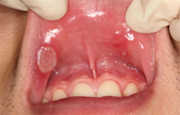 你以为是口腔溃疡 其实可能得了癌！赶紧张嘴看看