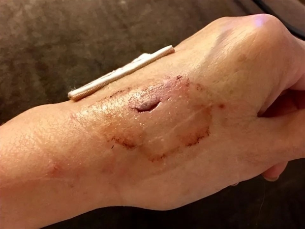 被人咬伤 感染概率高达55%!人嘴里到底有啥致病菌?
