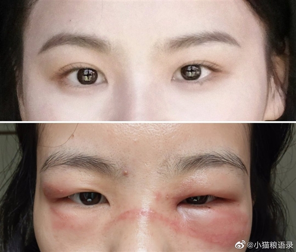 我的脸被隐翅虫毁容了!千万小心“会飞的硫酸”