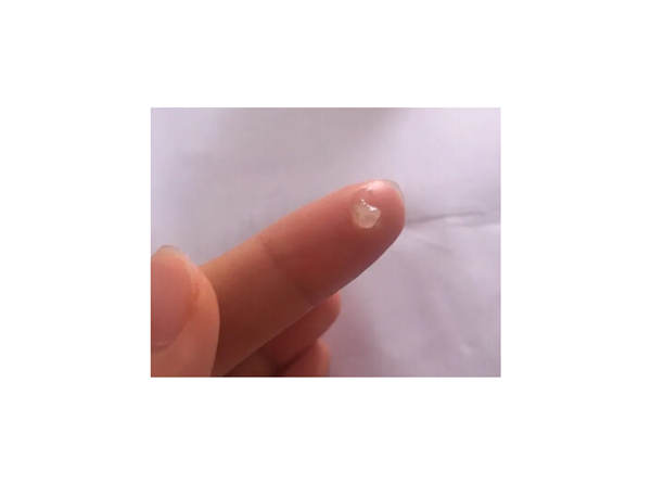重口味科普！嘴里咳出来贼臭的黄色小颗粒：到底是啥？
