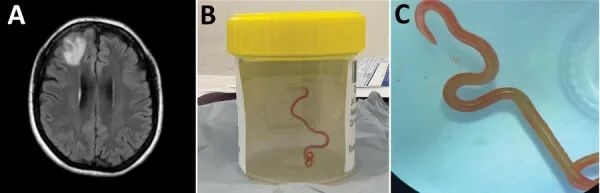 世界首例！人脑中发现长达8厘米的蛔虫：和吃有关