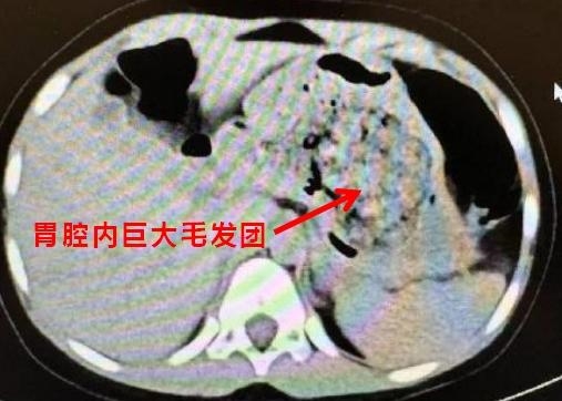 浙江一5岁女孩确诊长发公主综合征：胃里一大团头发 医生都懵了