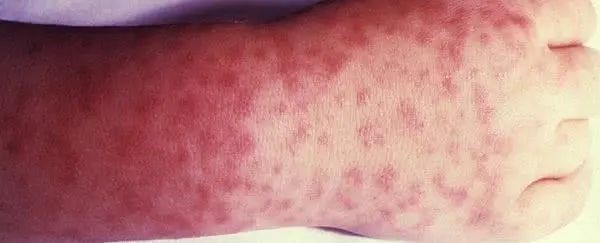 短短50年 超1亿人感染:莱姆病真的是美国生化武器泄漏?