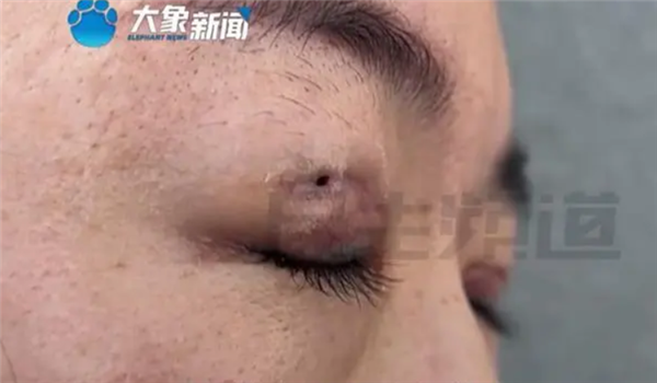 女子双眼皮修复后竟多了个洞！闭上眼还能看到外面