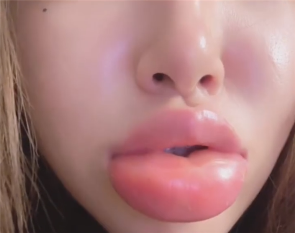 女生半夜嗦田螺 肿成香肠嘴:网友笑称终于超越梁朝伟