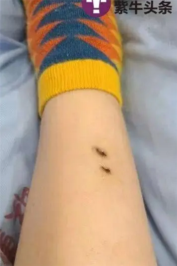 女子住酒店被毒蛇咬伤 酒店拒担全责有啥能证明引热议:律师发声