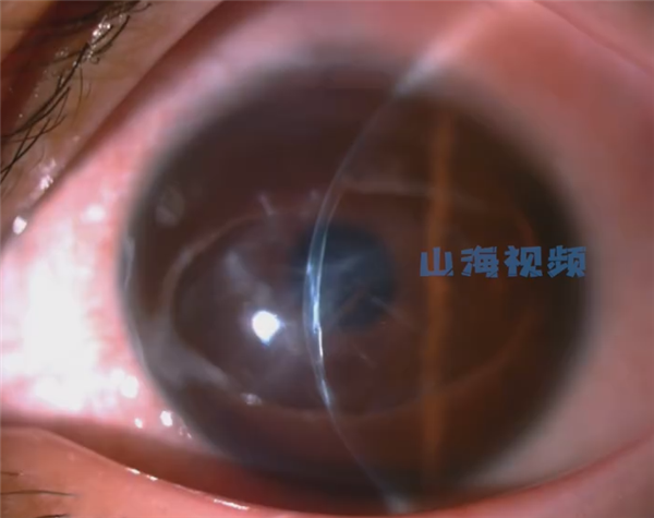 15岁男孩爱揉眼 2次揉掉视网膜:病因很奇特