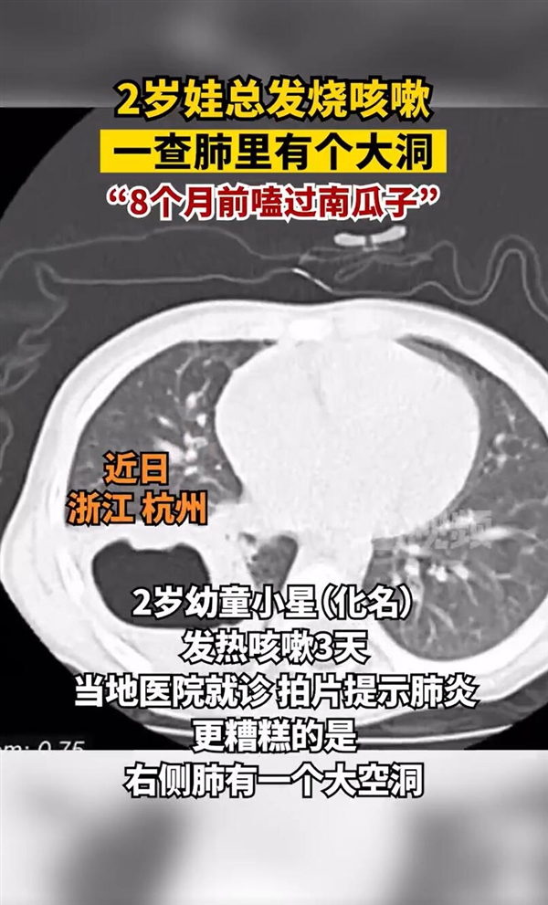 2岁娃总发烧咳嗽 一查肺里有个洞：8个月前嗑南瓜子 壳进入肺部