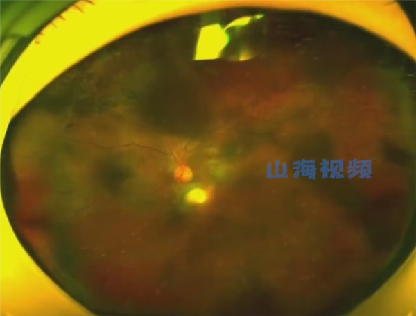 15岁男孩爱揉眼 2次揉掉视网膜:病因很奇特