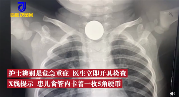 2岁娃咳嗽50天查出硬币卡喉 竟误吞5角硬币：网友看醉 家长心太大