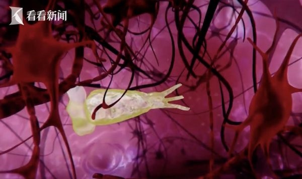 男子用自来水洗脸感染“食脑虫”死亡:死亡率高达97%