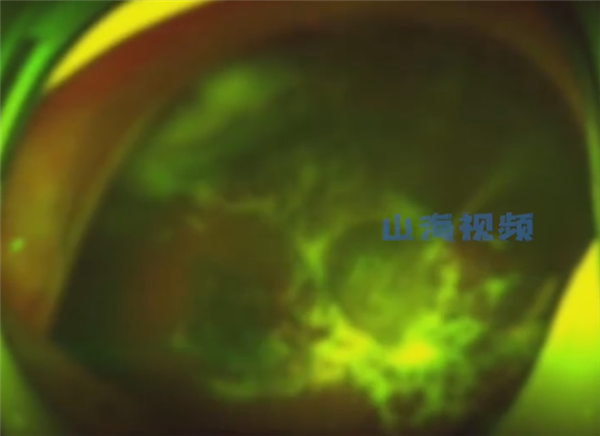 15岁男孩爱揉眼 2次揉掉视网膜:病因很奇特