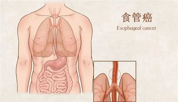 男子总拉肚子 竟查出5处癌：预防癌症 可注意这5点