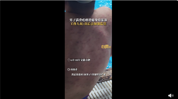 女子吐槽男子满背疙瘩进泳池游泳 不停掉皮屑引热议：还敢去公共泳池吗