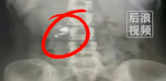 会“唱歌”的肚子!男子误吞蓝牙耳机胃里放音乐:自称戴耳机睡觉