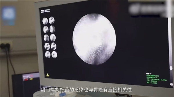 女生喝热水治胃痛 半年后查出胃癌:65℃以上是2A类致癌物