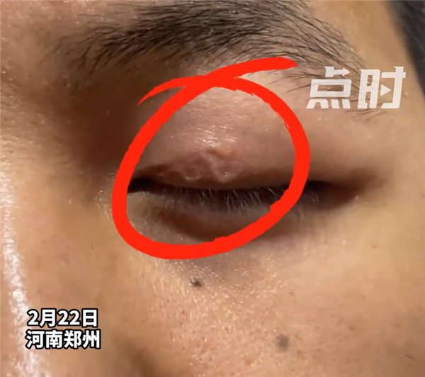 男子左眼皮异常抖动有虫游走:暂无治疗方案