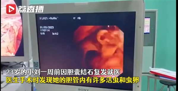 女子爱吃生腌海鲜:胆管长满活虫和虫卵