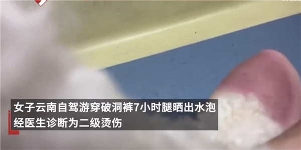 女子云南穿破洞裤7小时腿被晒伤 诊断是二级烫伤:为找跑丢的狗