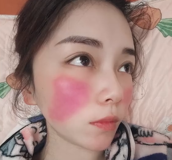 女子高烧39度 脸颊烧红如两大块斑：网友科普 千万别大意