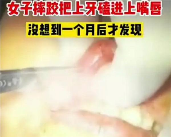 女子摔跤上牙磕进嘴唇1月后才发现 医生惊叹不已：网友直呼心太大
