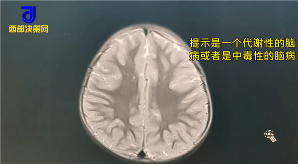 父母抹酒精退烧致4岁女儿住进ICU：酒精渗入皮肤引中毒
