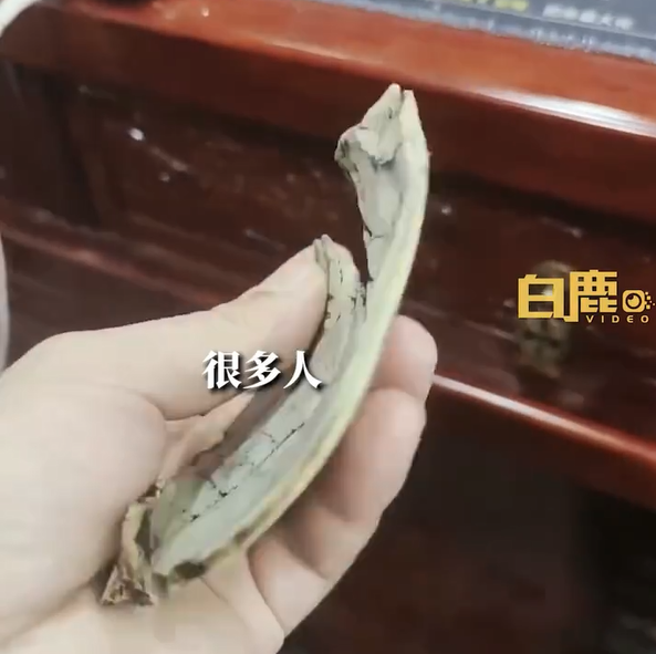 男子术后晒颅骨碎片：最薄之处像指甲 一捏就碎
