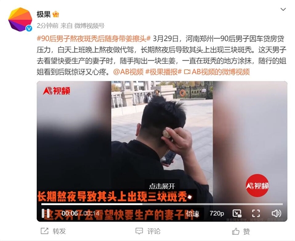 90后男子熬夜斑秃后随身带姜擦头 当事人姐姐：既惊讶又心疼