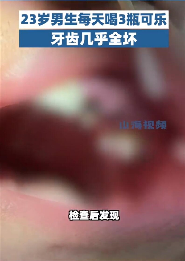 00后男生长期把可乐当水喝:牙全坏