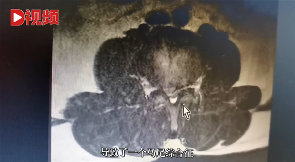 连续开车8小时!男子长期久坐后被诊断截瘫 医生提醒