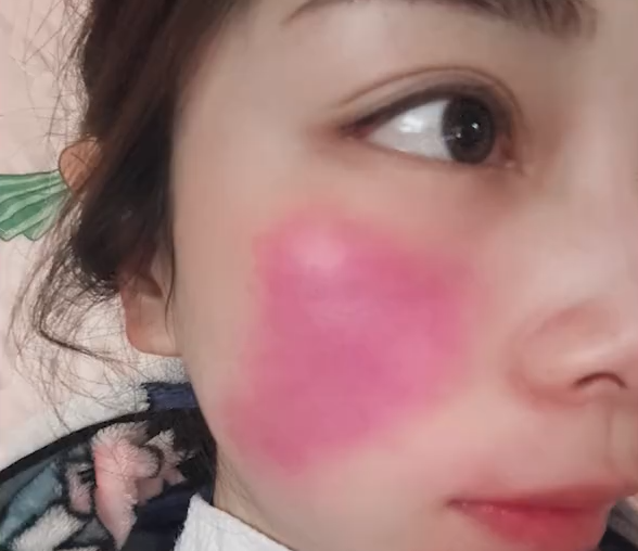 女子高烧39度 脸颊烧红如两大块斑：网友科普 千万别大意