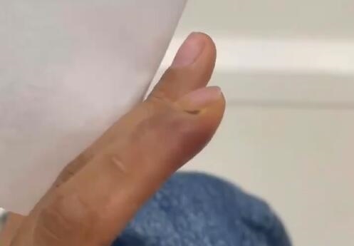 女子拔倒刺致骨髓炎要刮骨手术 医生：处理不当有截肢风险