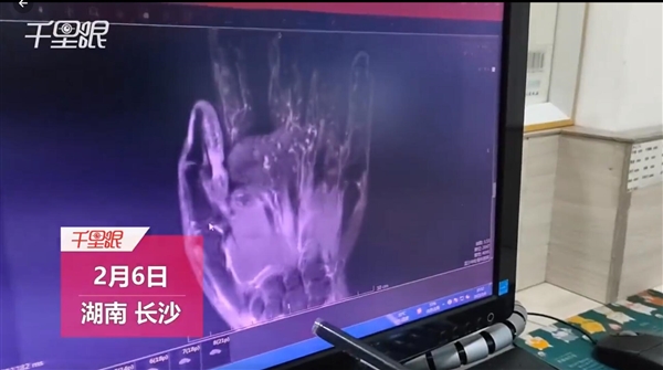 女子用力脱秋裤致手指肌腱断裂 医生：再严重点就要肌腱移植了