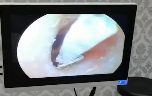 女生睡觉不摘耳钉：直径4mm钻掉耳道 卡了半个月